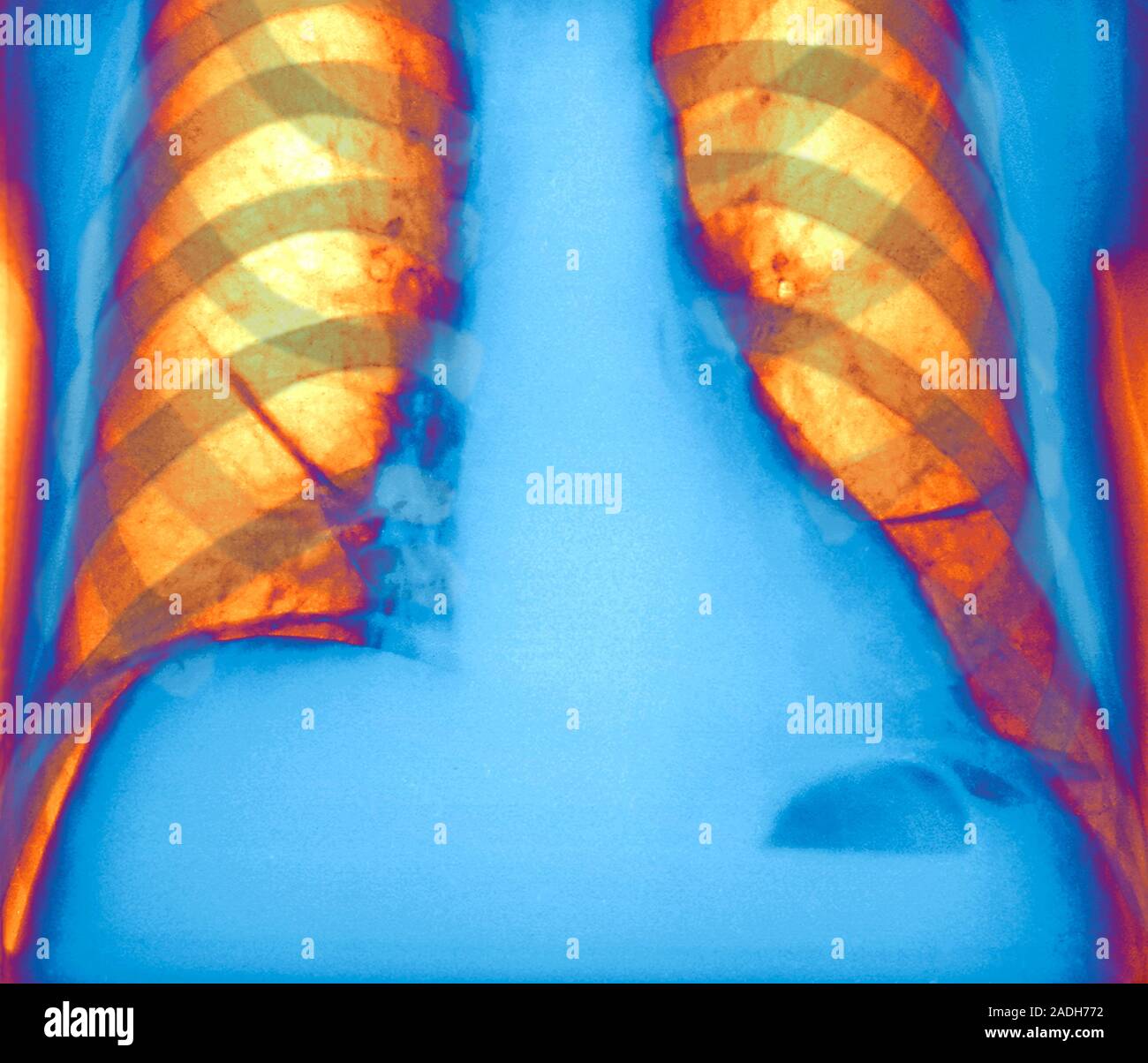 Collapsed lung, coloured X-ray. Collapsed left lung (right, atelectasis) as a result of the abnormal presence of gas (pneumoperitoneum). This gas is s Stock Photo