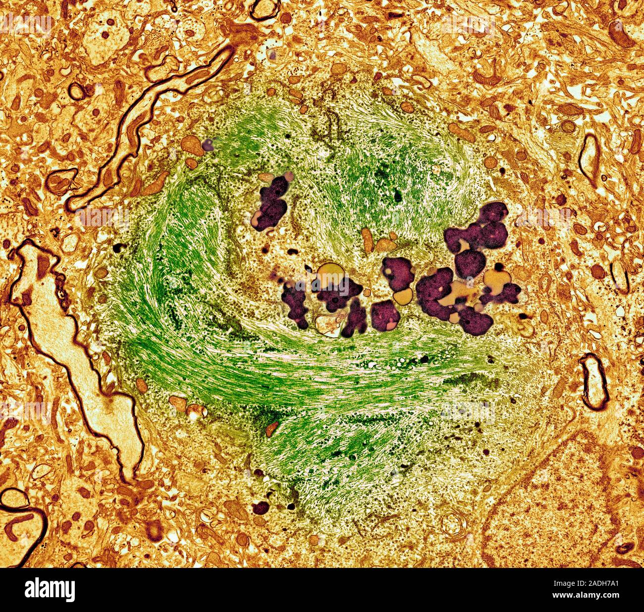 Tem Brain Alzheimer's disease brain cell. Coloured transmission electron ...