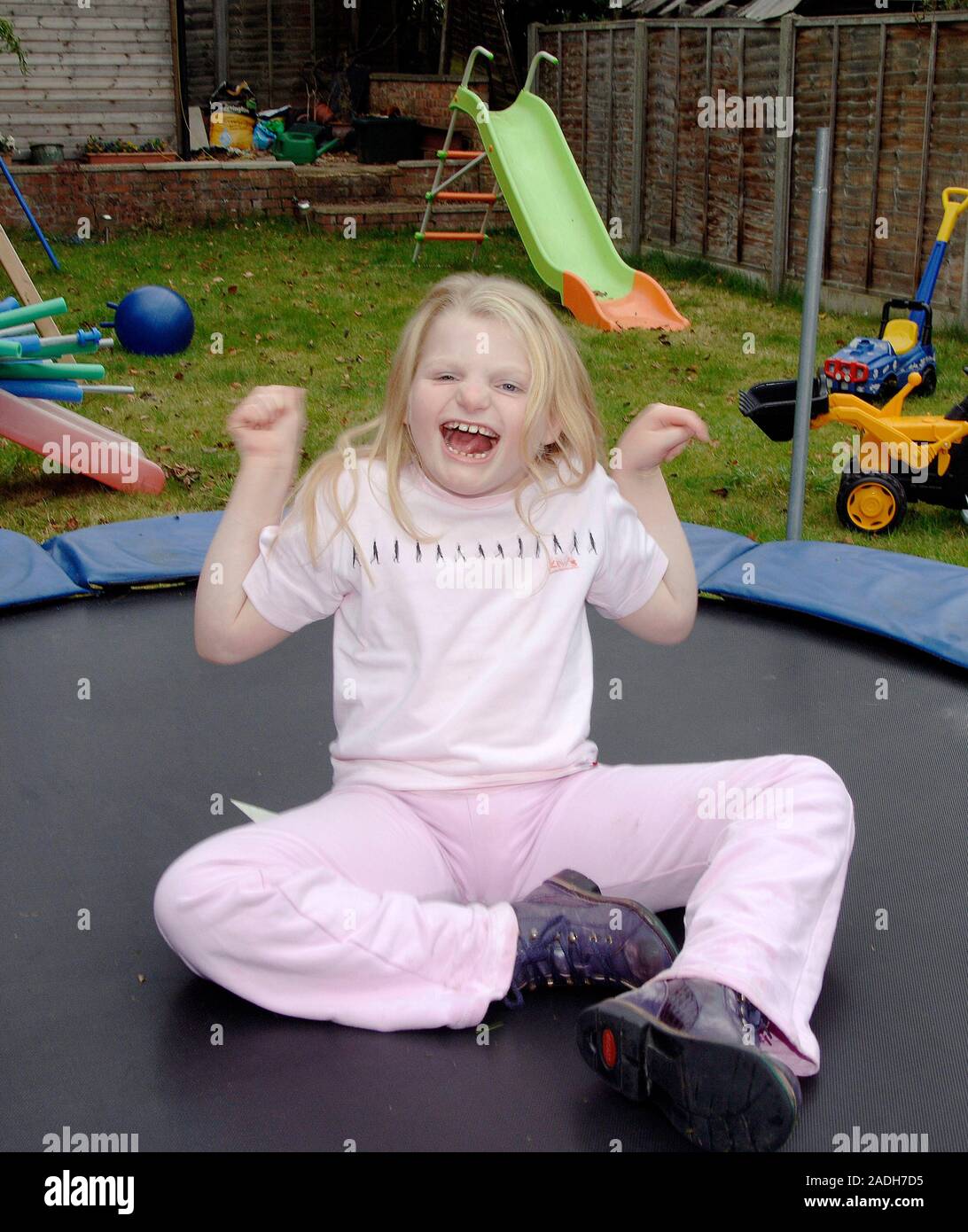 MODEL RELEASED. Angelman Syndrome. 10-year-old Girl With Angelman