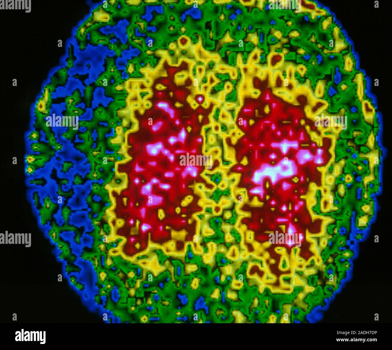 Falsecolour scintigram (gamma camera scan) of the lungs of an