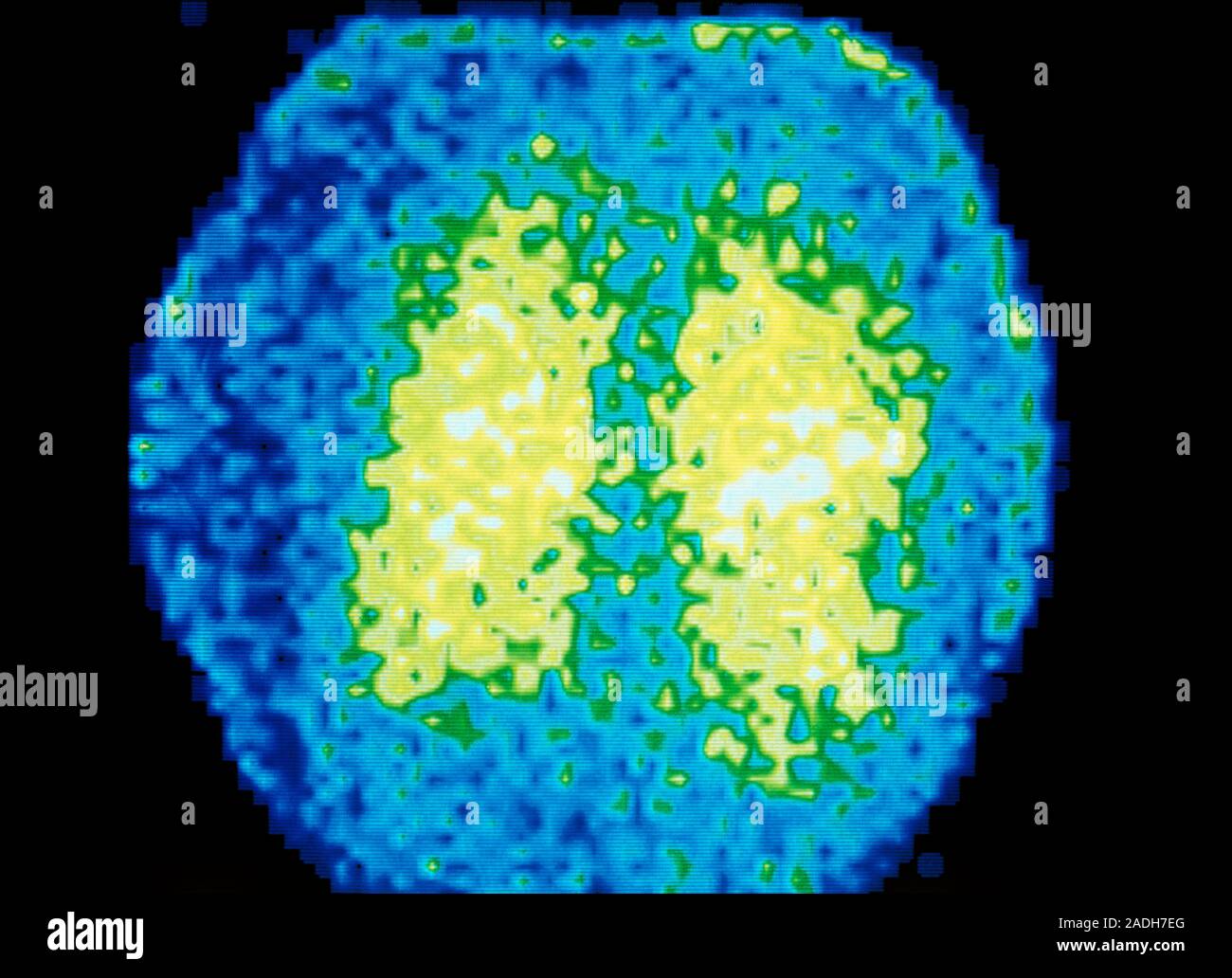 Falsecolour scintigram (gamma camera scan) of the lungs of an