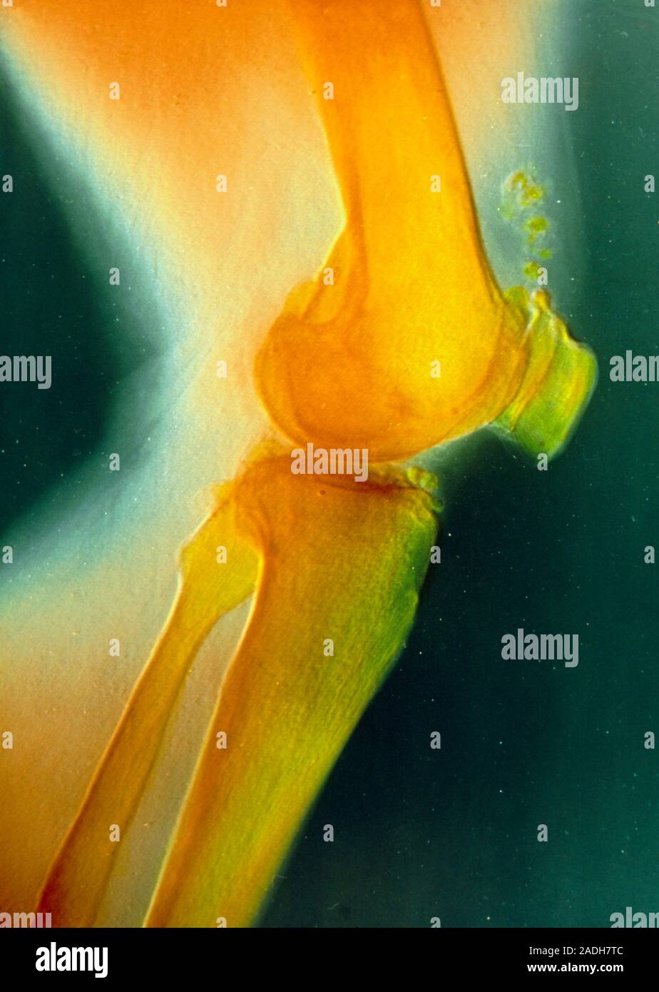 Falsecolour Xray of an arthritic knee joint, showing the erosion of