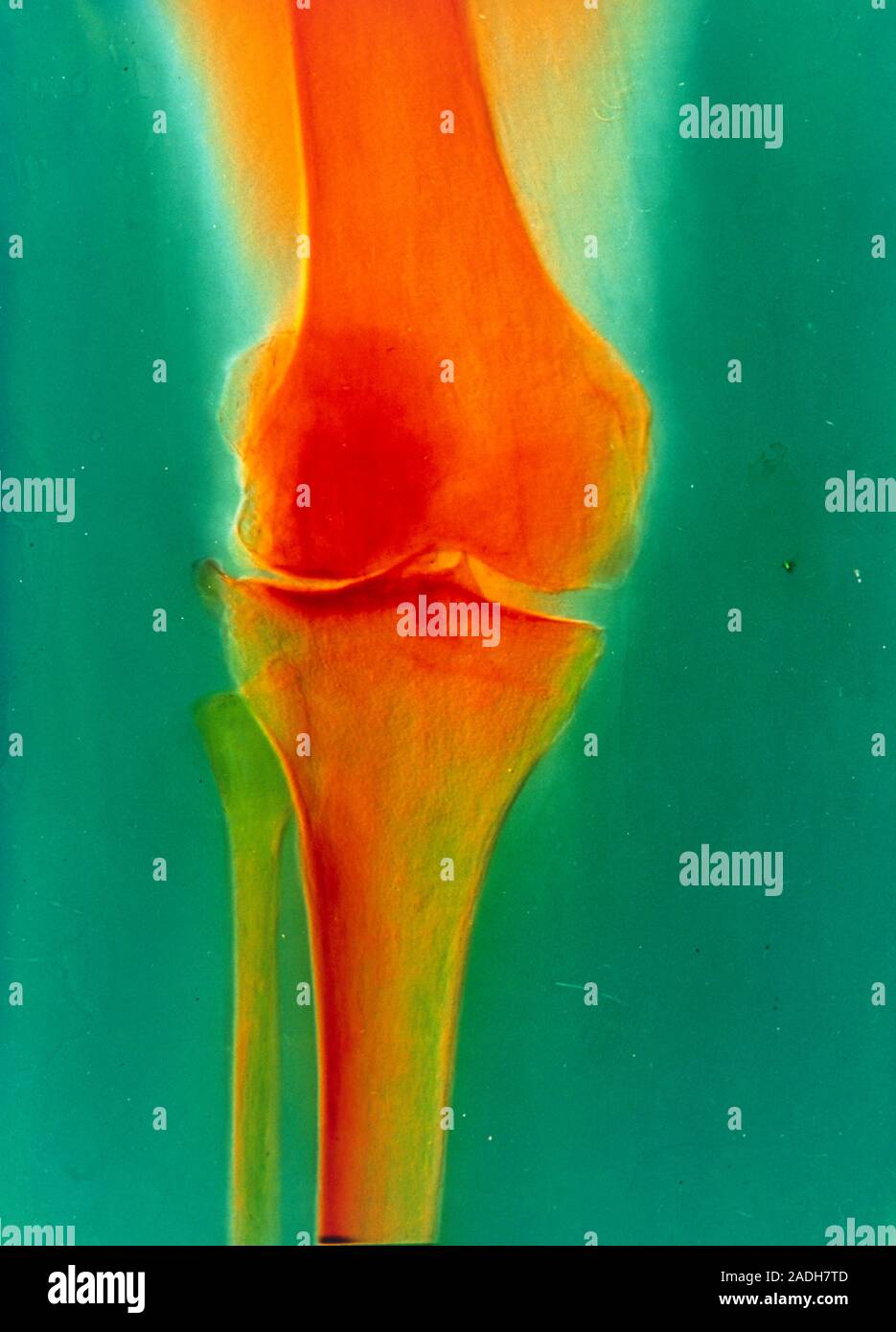 Falsecolour xray of an arthritic knee joint, showing erosion of