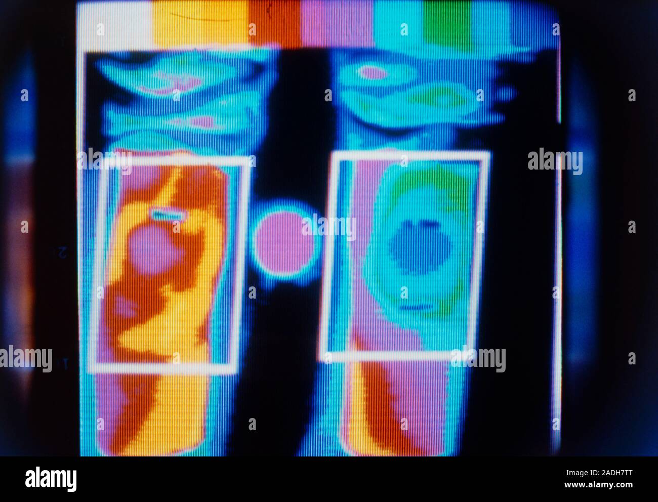 Thermogram comparing a normal and arthritic knee; the inflamed