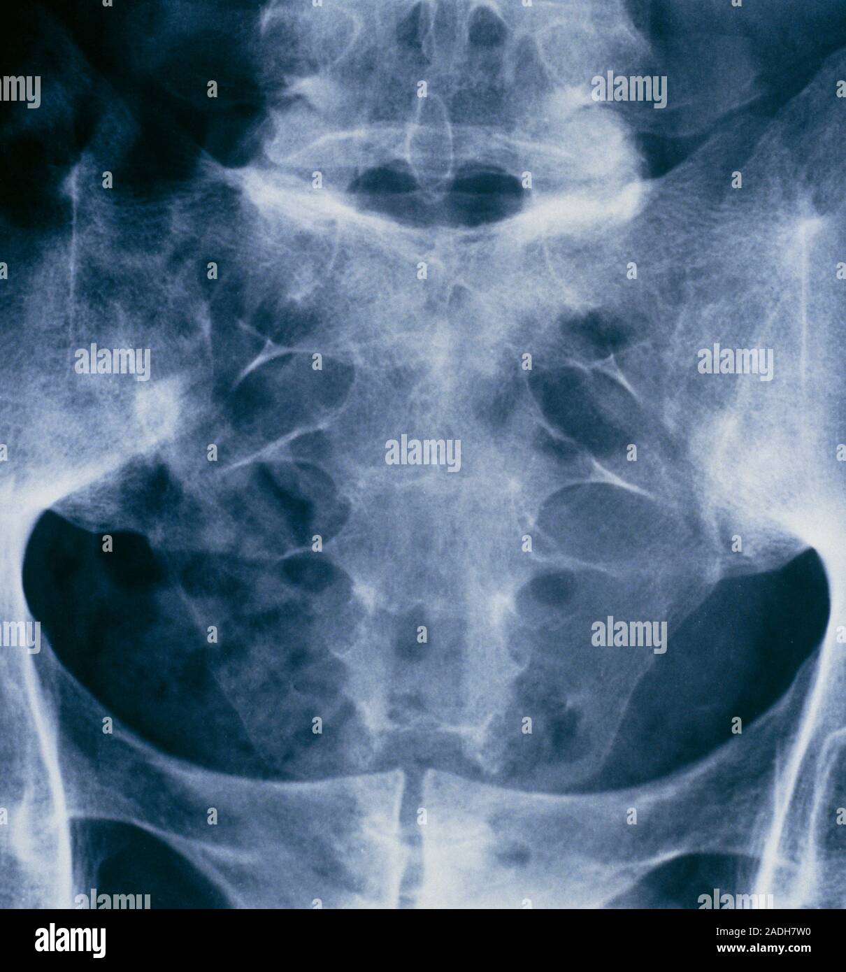 Артроз илеосакрального сочленения. Артроз крестцово-подвздошного сустава. Артроз илеосакральных сочленений степени. Крестцово-подвздошный артроз. Анкилоз крестцово-подвздошных сочленений кт.