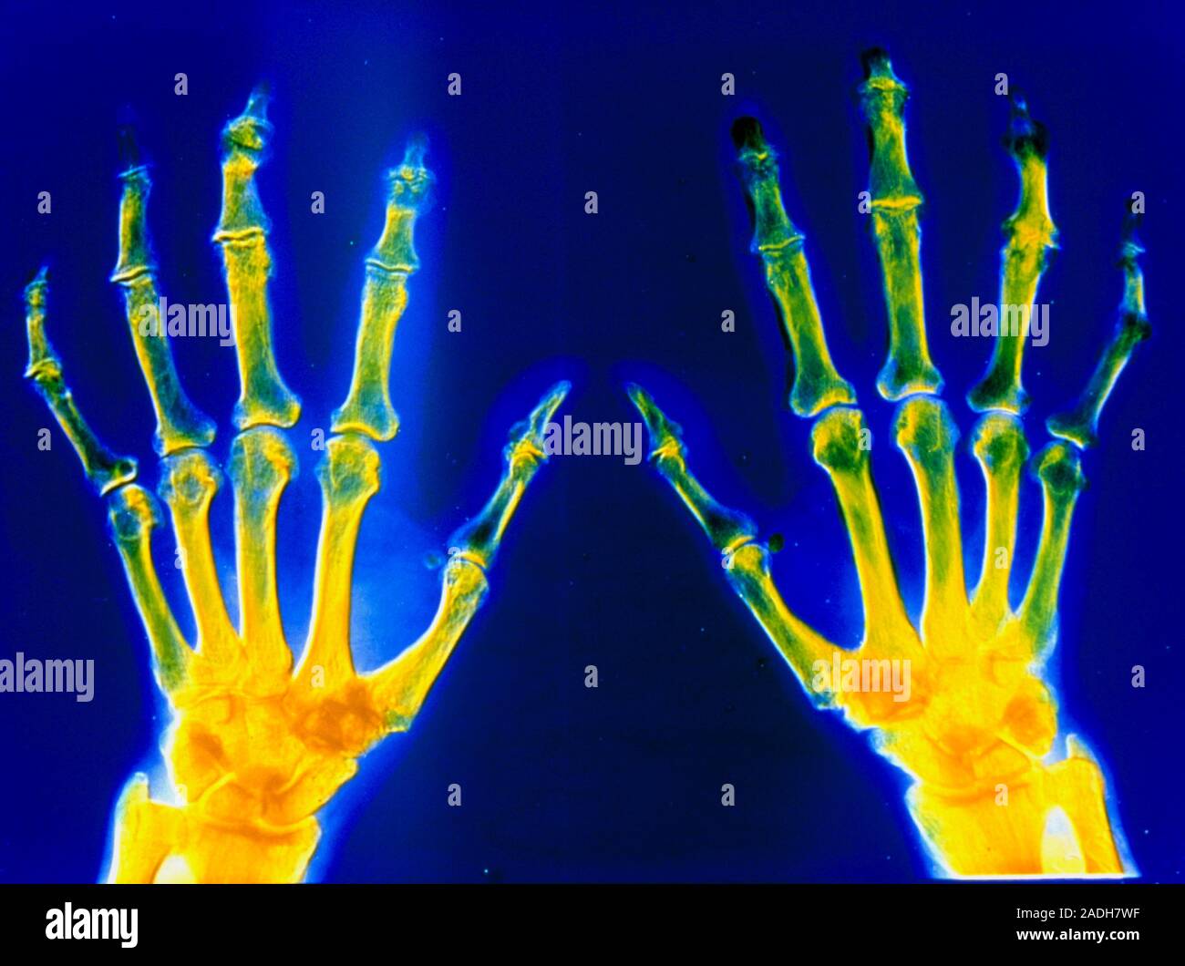 False-colour X-ray image of the human hands showing deformation in the ...