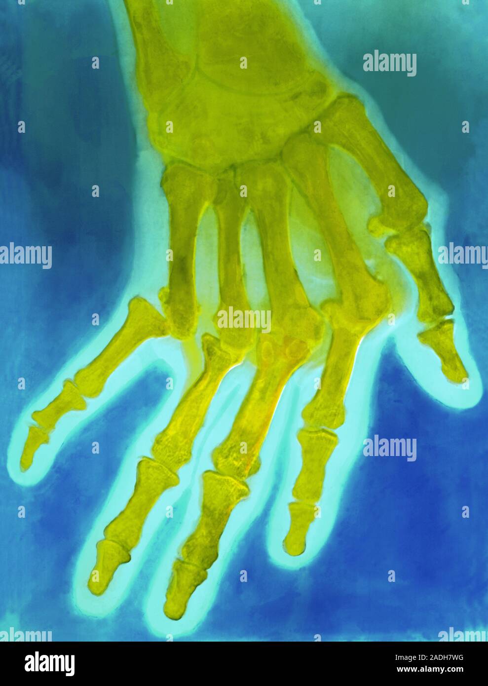 False-colour X-ray image of the human hand showing deformation in the ...