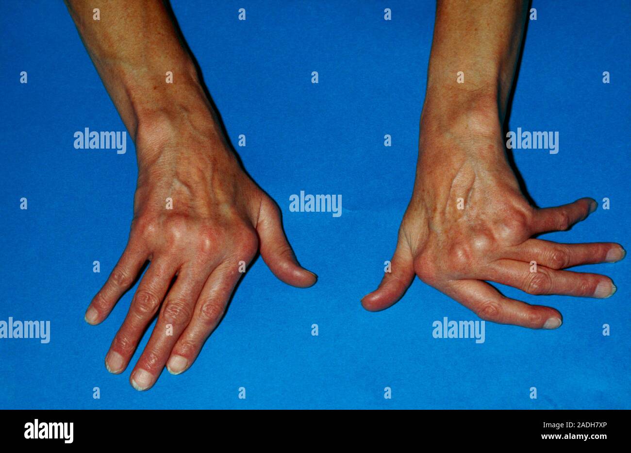 Deformed joints in both hands of a patient suffering from rheumatoid