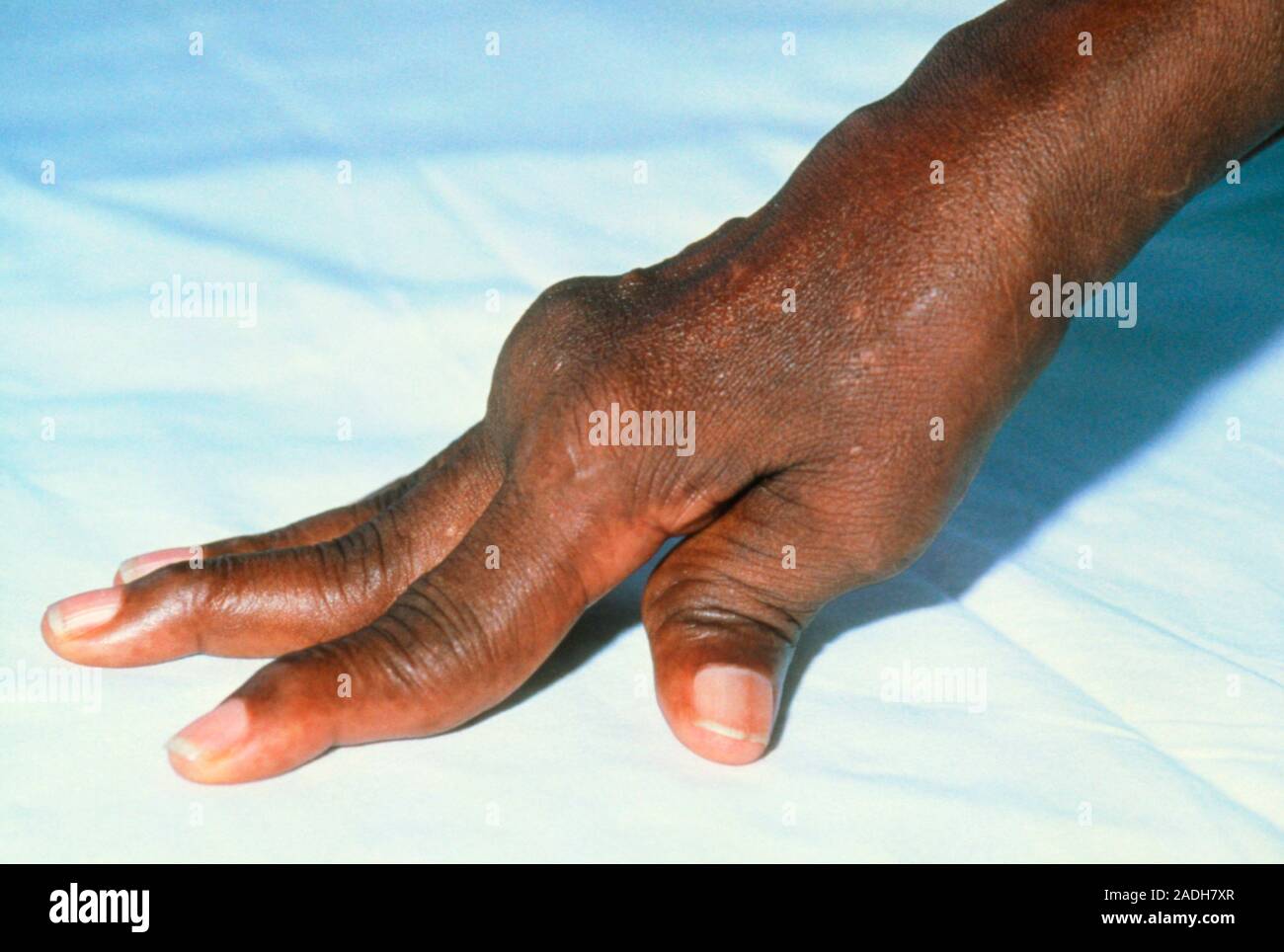 A swan neck" deformity of the hand in a Jamaican patient suffering from rheumatoid arthritis