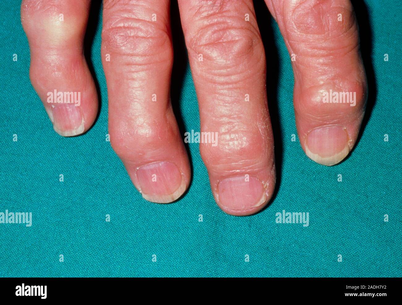 Heberden's node on fingers. A hand affected by osteoarthritis showing