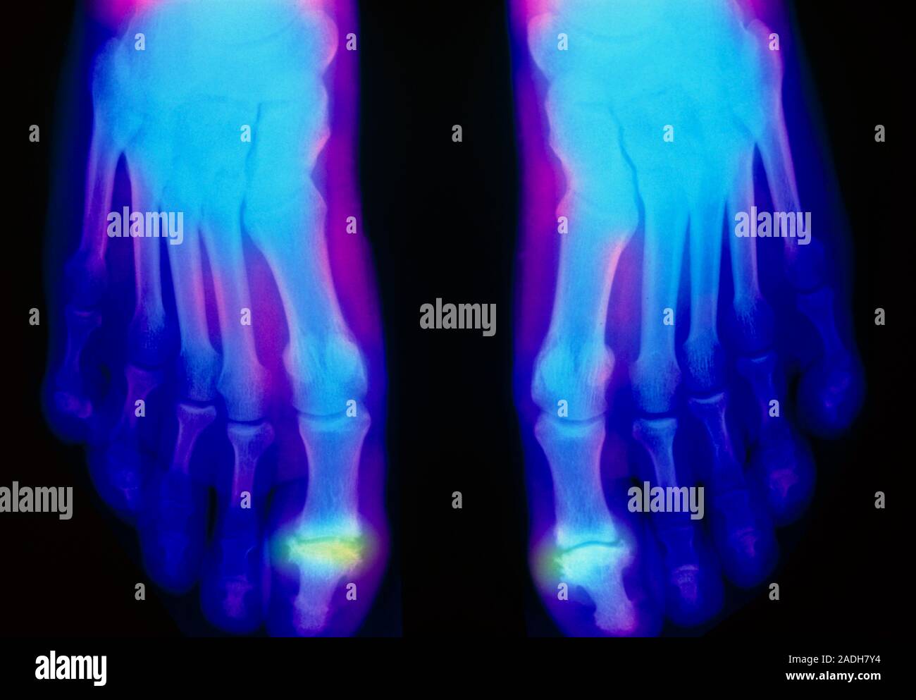 Rheumatoid arthritis. Falsecolour Xrays showing destruction of the toe joints in both feet due