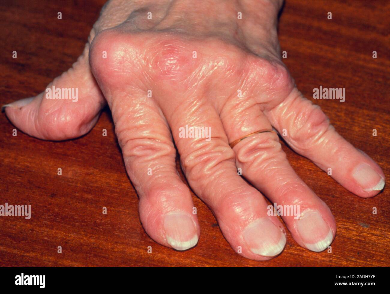 Arthritic hand. Close-up of deformed hand due to rheumatoid arthritis. The knuckles (metacarpo phalangeal joints) are swollen and reddened and the fin Stock Photo