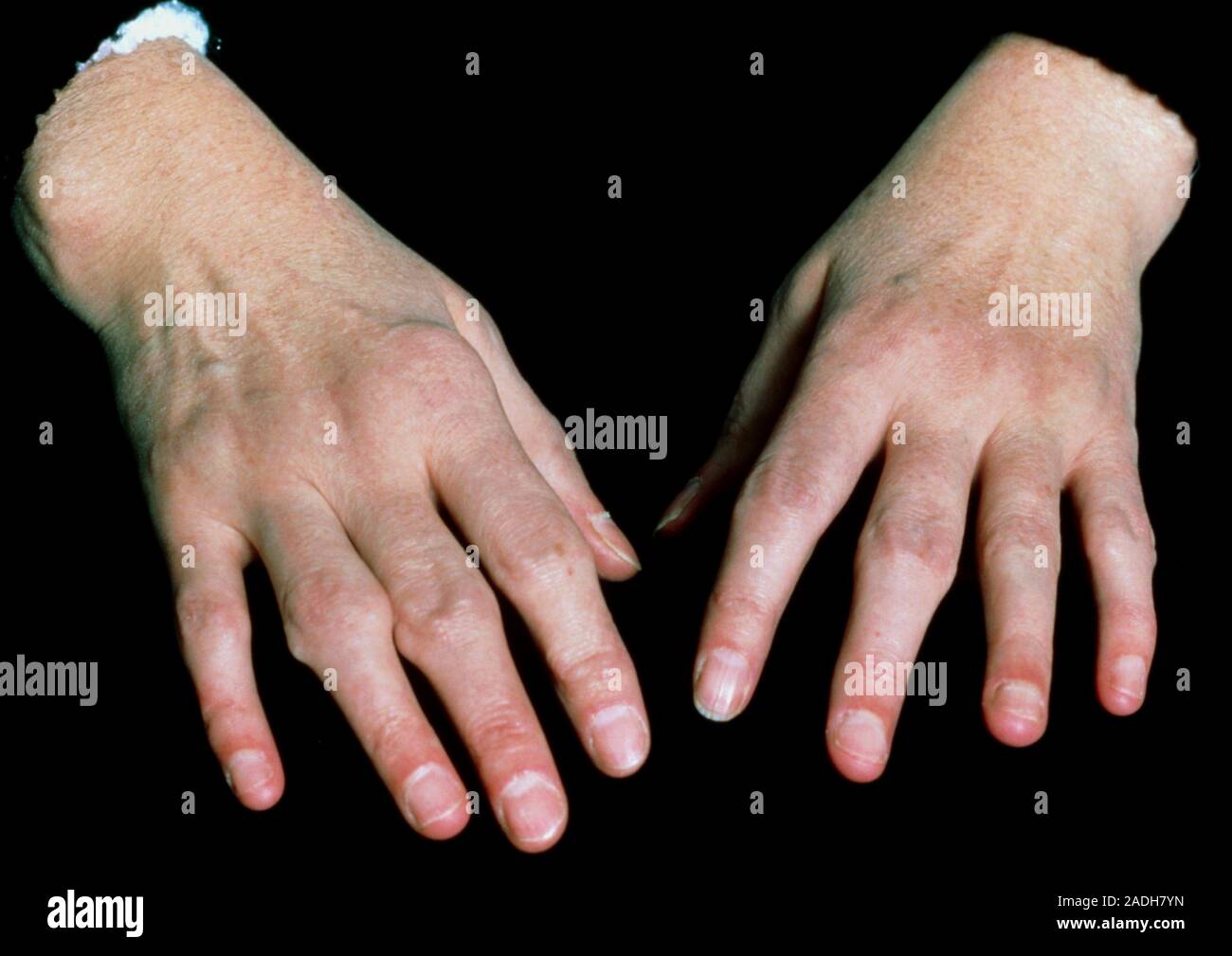 Rheumatoid arthritis. The hands of a patient suf fering from