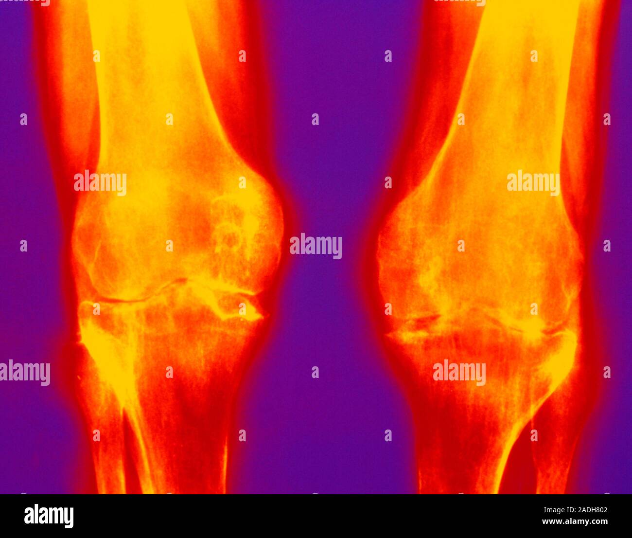 Coloured Xray showing erosion of both knee joints due to rheumatoid