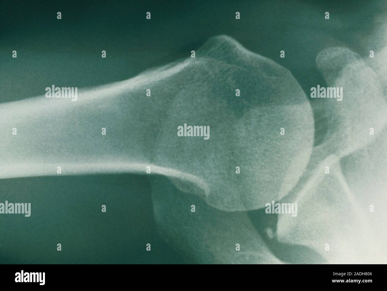 Tendon calcification in the shoulder joint. Xray of a shoulder joint