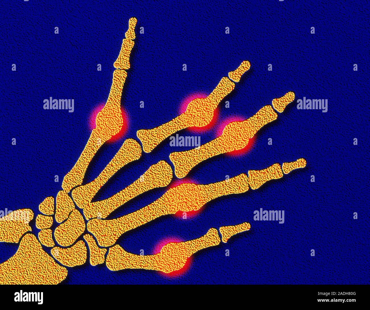 Rheumatoid arthritis. Computer artwork of bones of the human hand, showing joints affected by