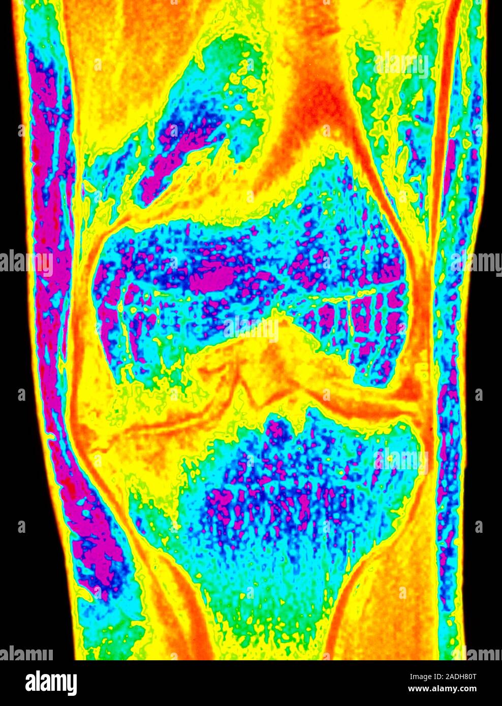 Osteoarthritis of knee. Colour Resonance Imaging (MRI) scan of a front view of the knee