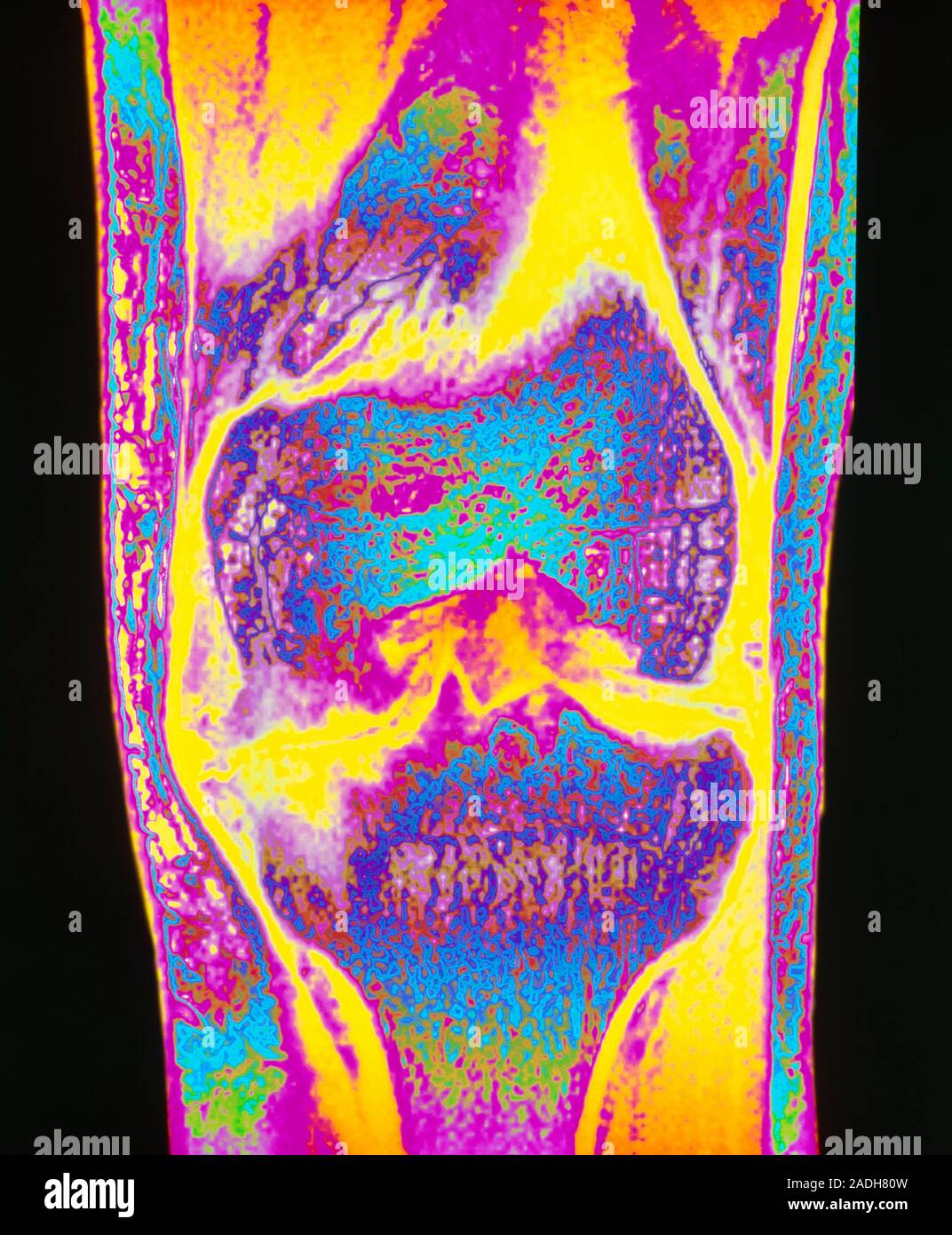 Osteoarthritis of knee. Colour Resonance Imaging (MRI) scan of a front view of the knee