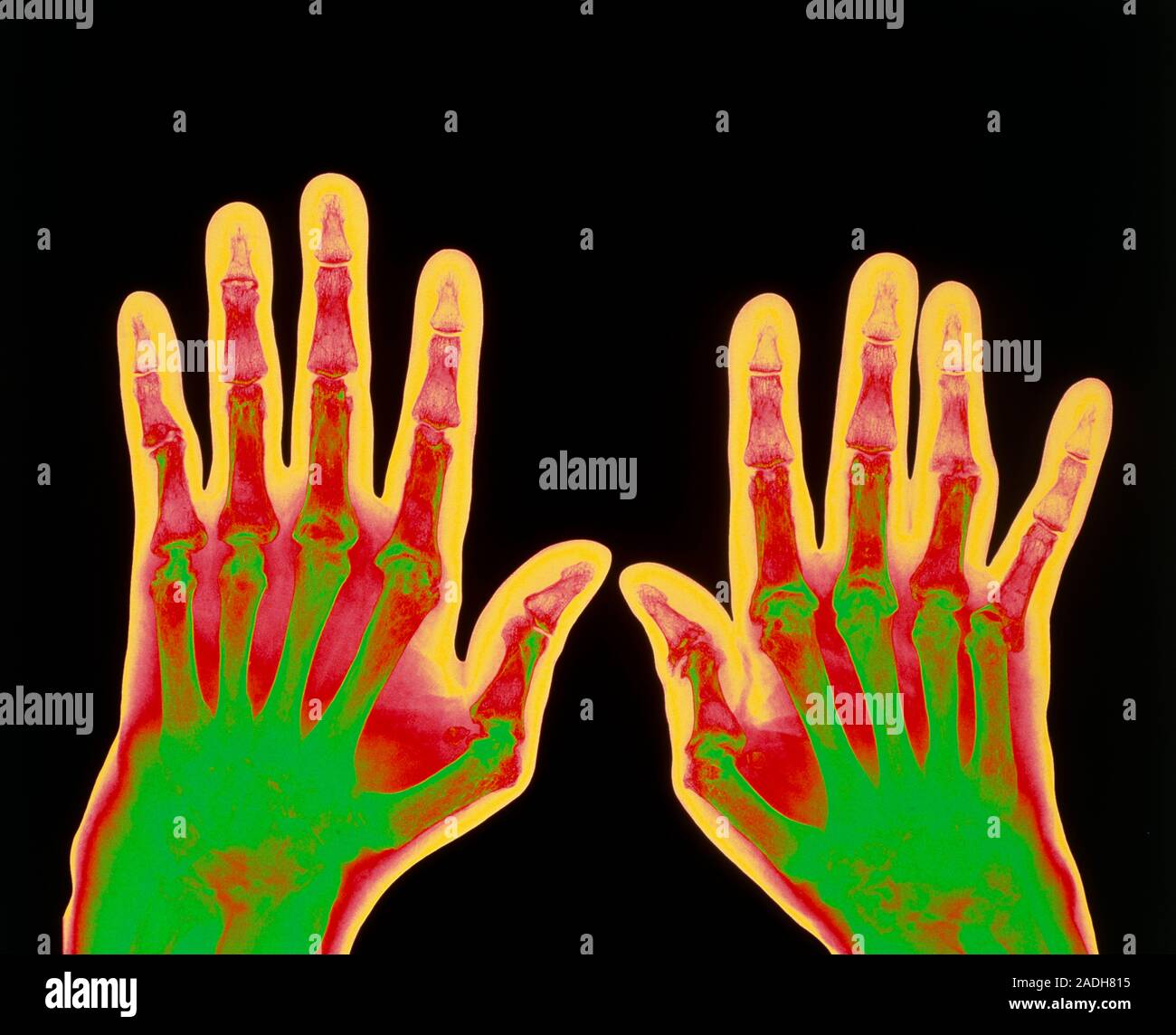 Arthritic hands. Coloured Xray of hands suffering from severe