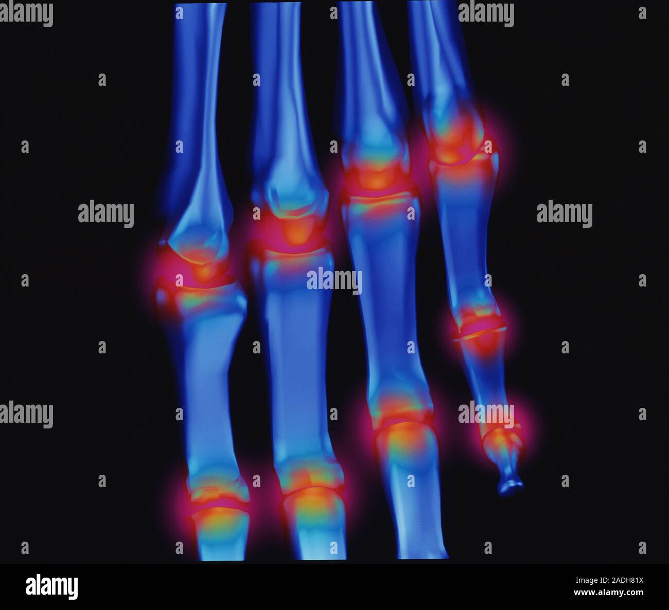 Arthritis. Computer artwork of arthritis affecting the joints of the fingers. The pain and