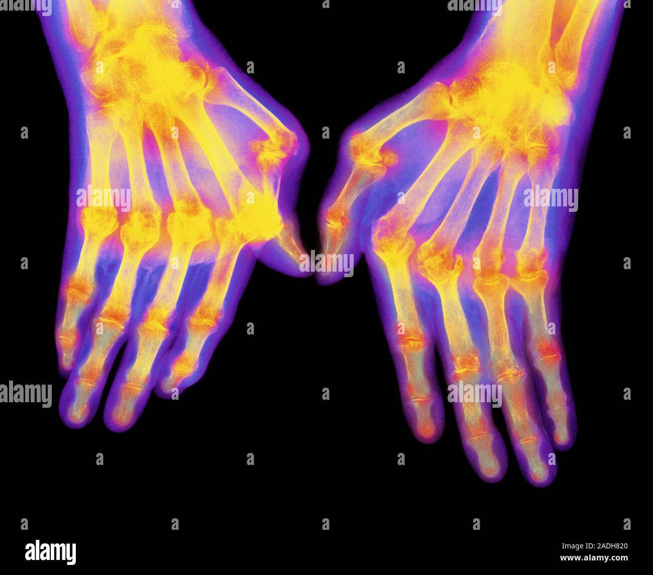Arthritic hands. Coloured computerenhanced Xray of hands suffering