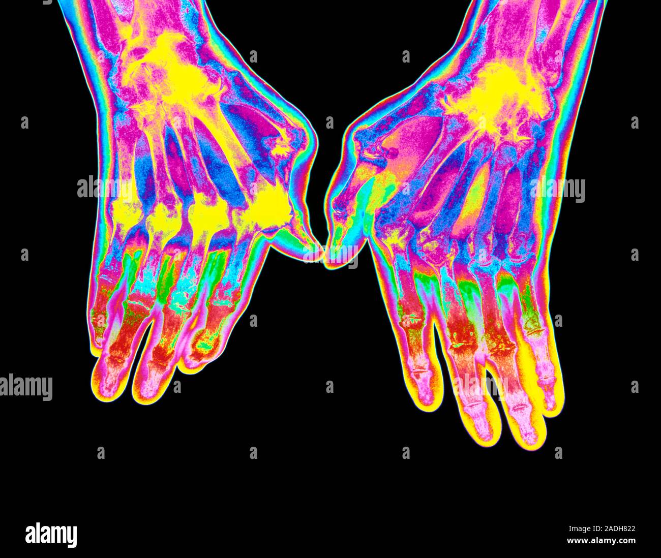 Arthritic hands. Coloured computerenhanced Xray of hands suffering