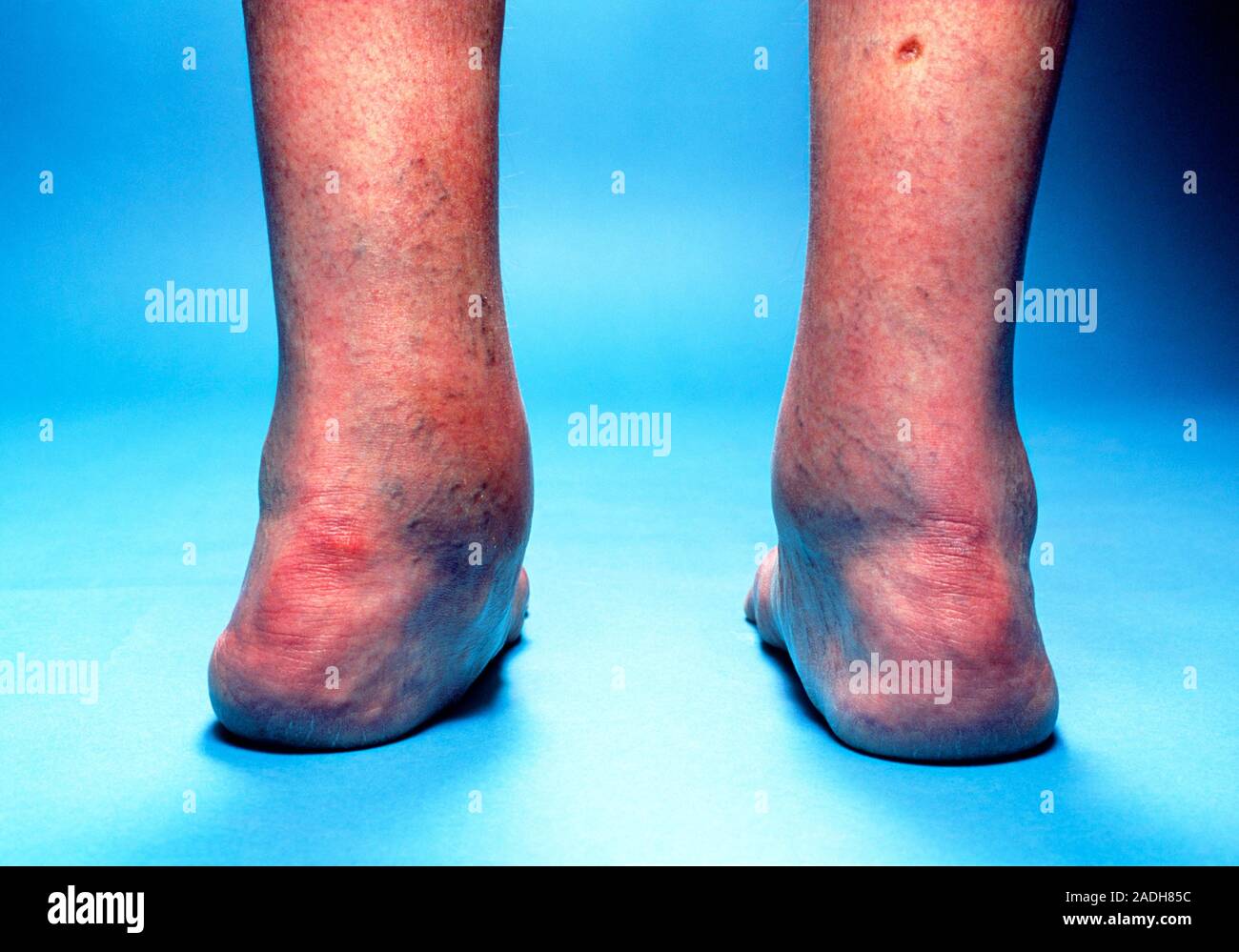 Rheumatoid arthritis. View of a patient's feet showing valgus