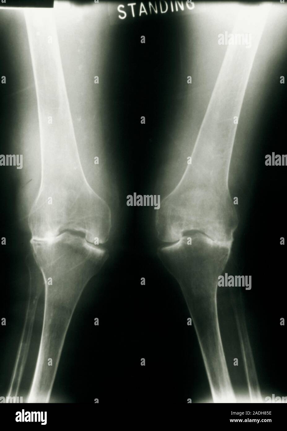 Arthritic knees. Xray showing deformation of the knees caused by