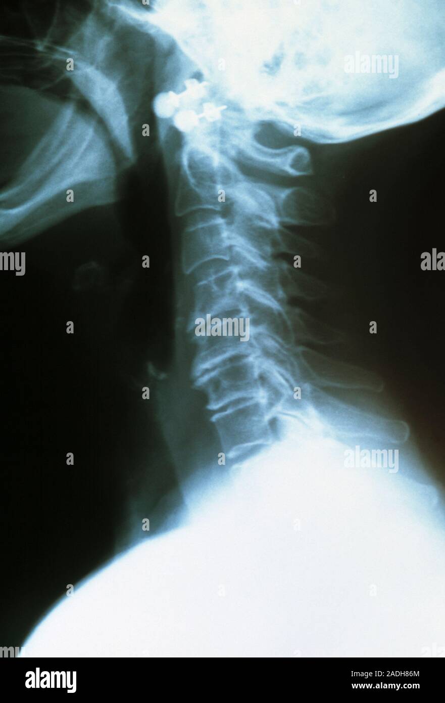Osteoarthritis. Xray of the neck of a 79 year old woman with
