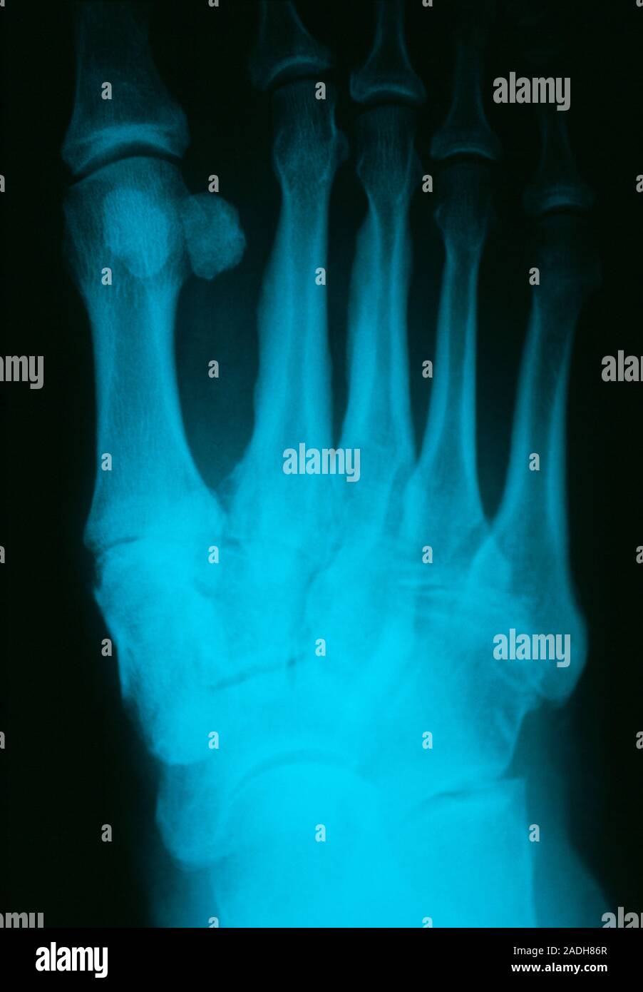 Osteoarthritis. Xray of the foot of a 57yearold woman with osteoarthritis. The metatarsals