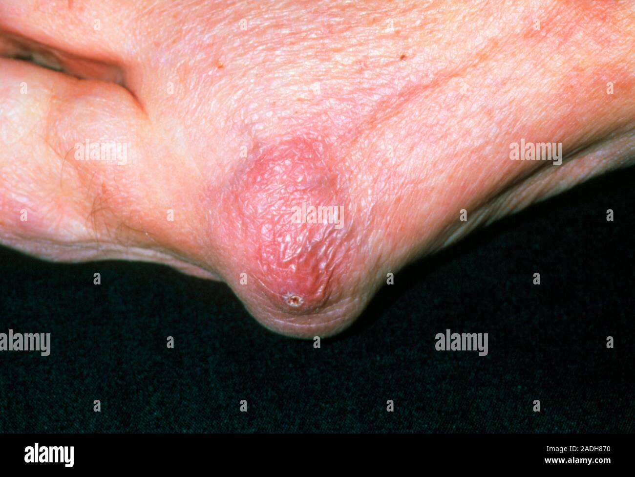 Rheumatoid arthritis nodule. Hard swelling (nodule) on the thumb of a