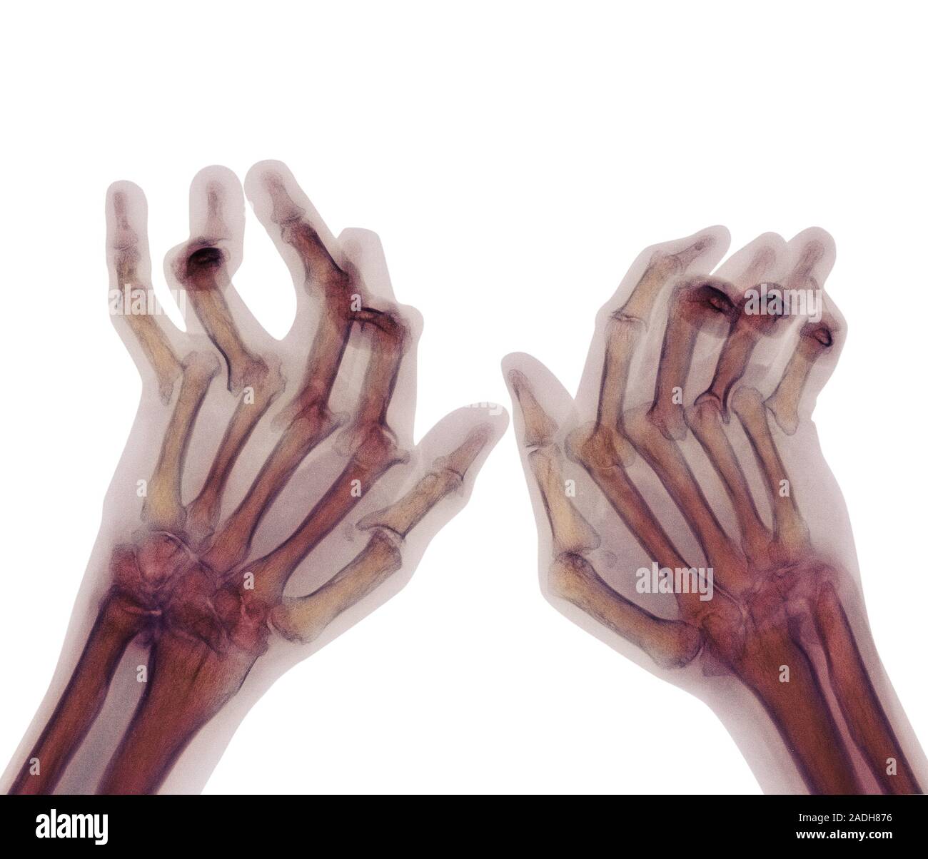 Arthritic hands. Coloured Xray of the deformed hands of a patient