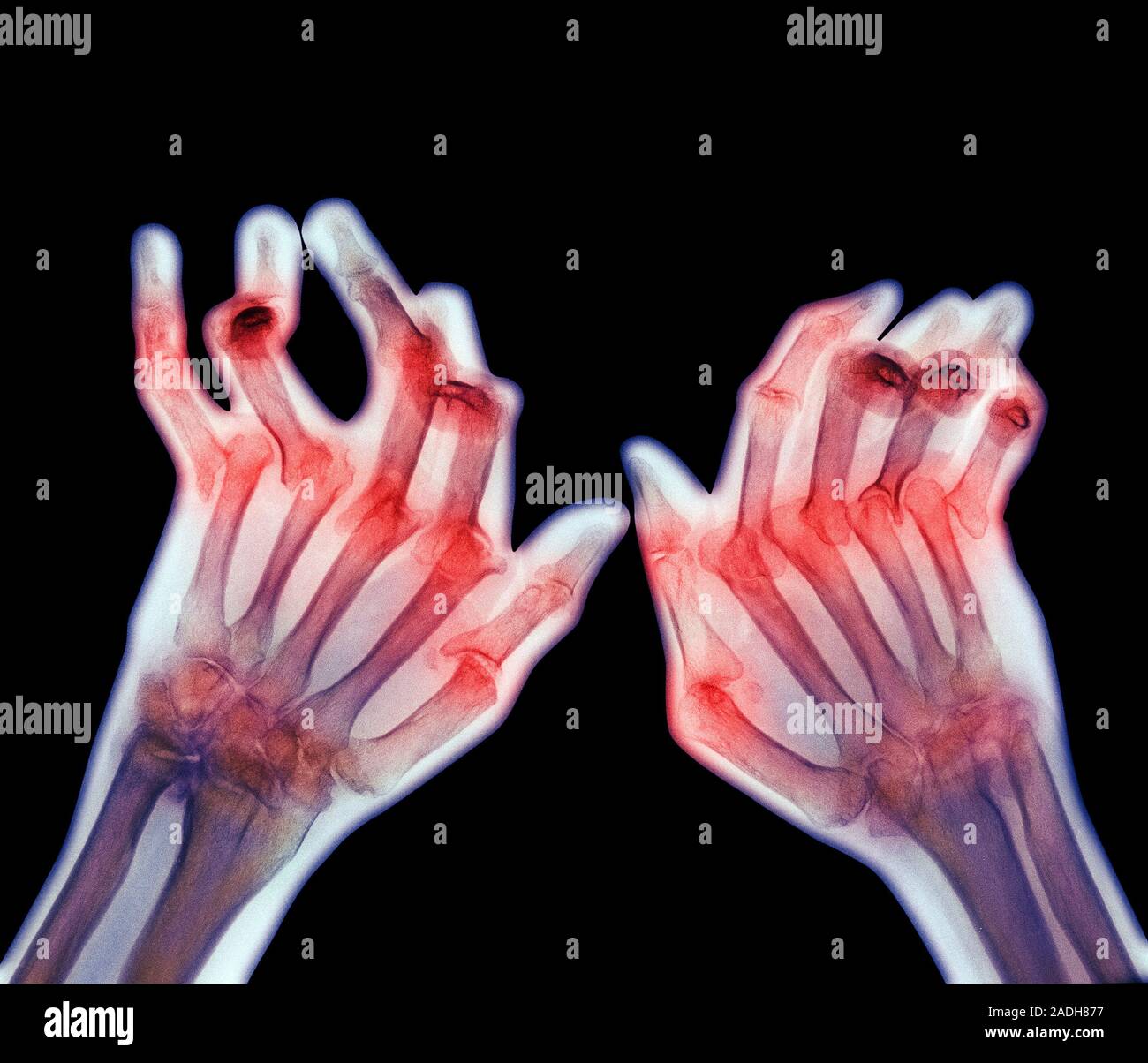 Arthritic hands. Coloured Xray of the deformed hands of a patient