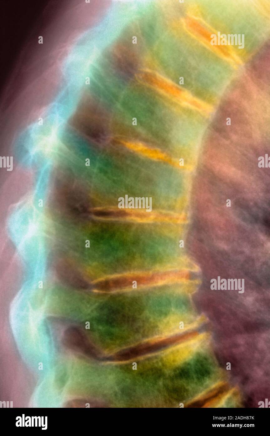 Arthritis of the spine, coloured Xray. The discs of cartilage (yellow