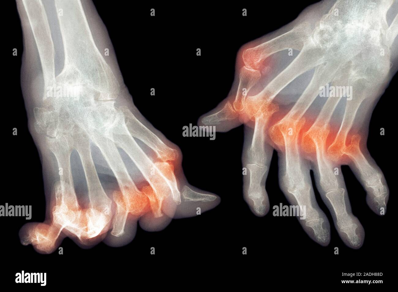 Arthritic hands. Coloured Xray of the deformed hands of a patient