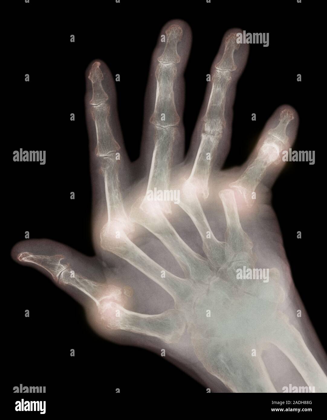 Arthritic hand. Coloured Xray of the deformed hand of a patient