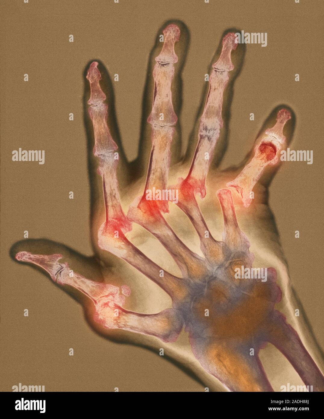 Arthritic hand. Coloured X-ray of the deformed hand of a patient ...