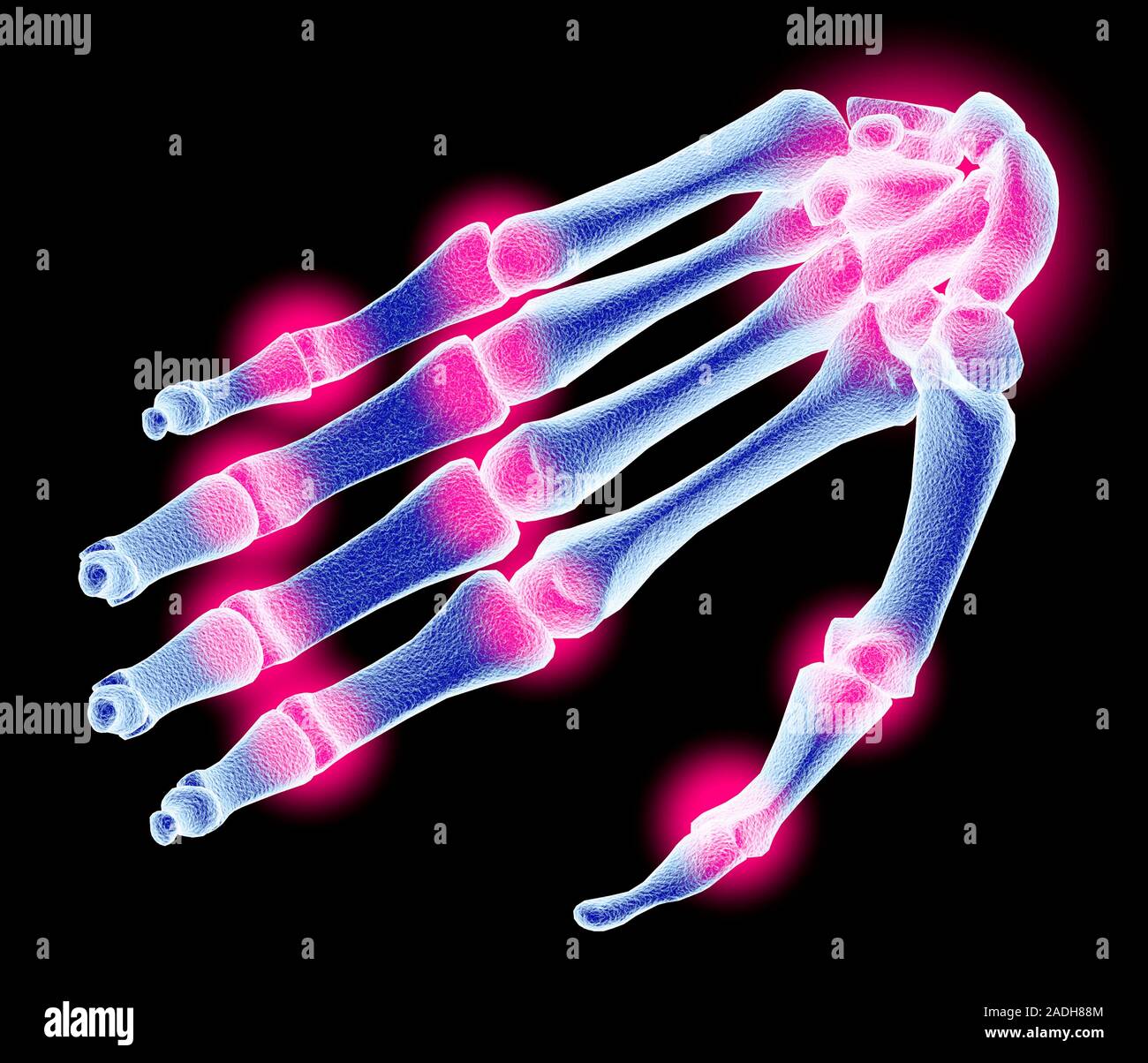 Arthritis. Computer artwork of arthritis affecting the joints of the hand. The pain and