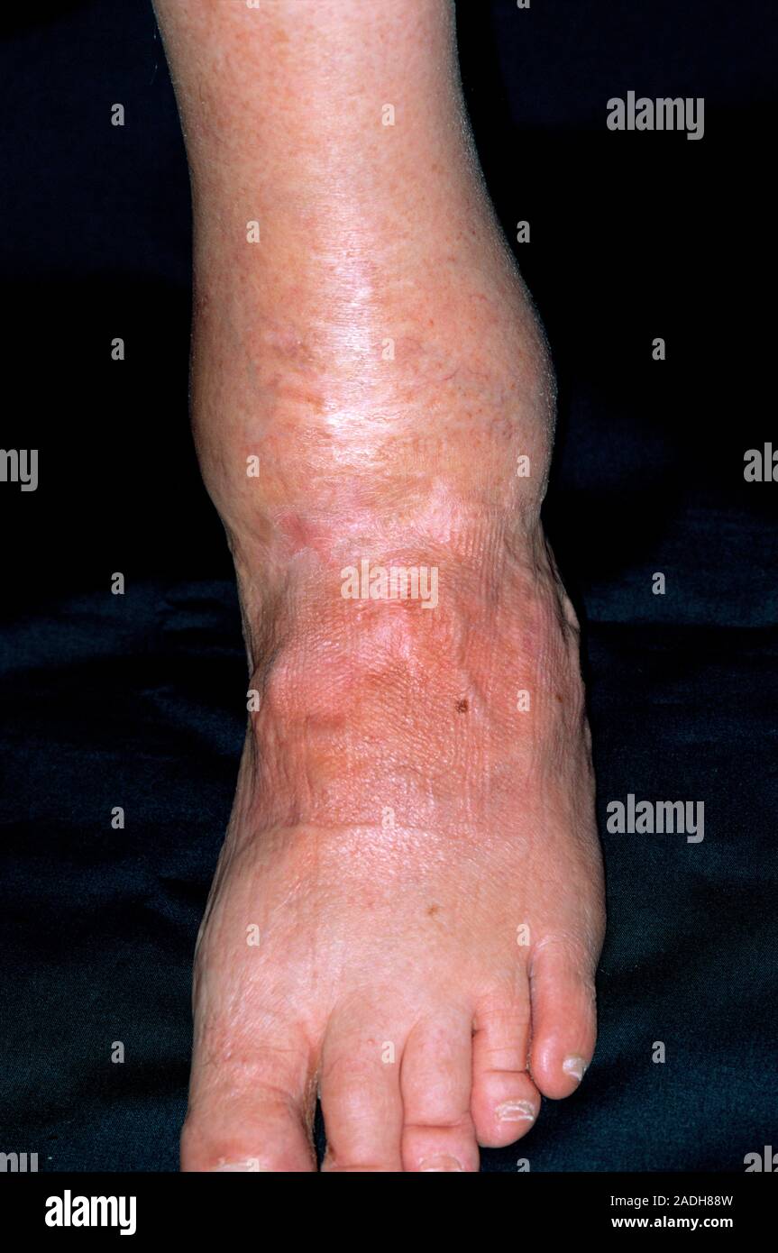 Arthritis. Ankle of a 66yearold man suffering from osteoarthritis. Osteoarthritis is a joint