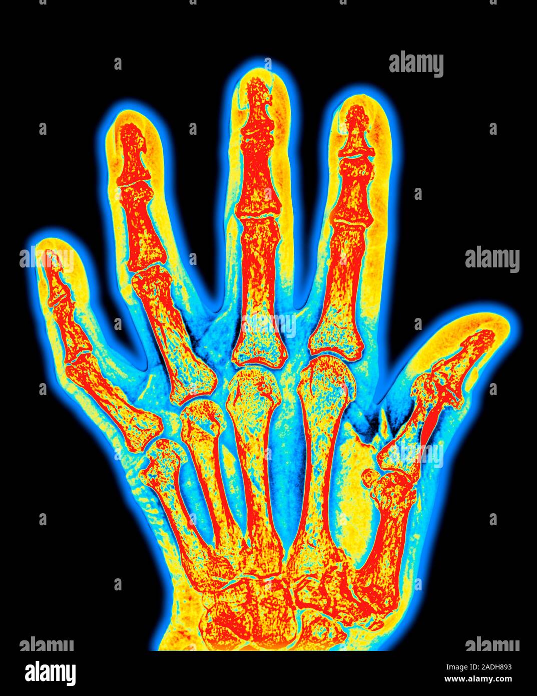 Arthritis. Coloured Xray of arthritis affecting the joints of the hand