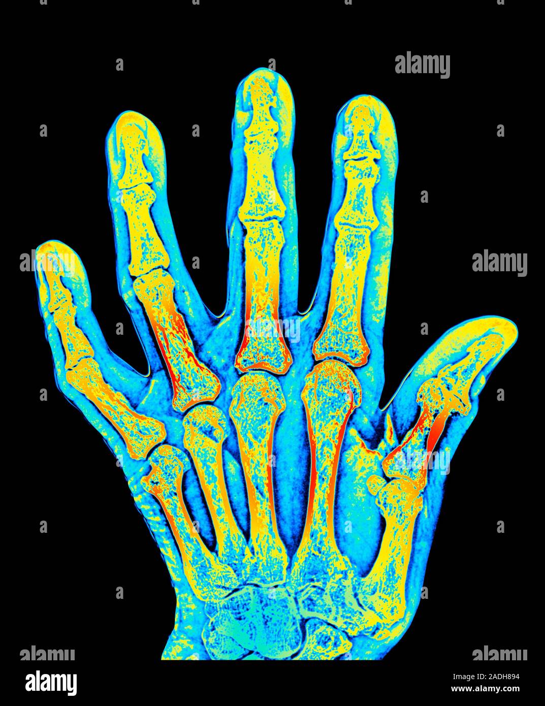 Arthritis. Coloured X-ray of arthritis affecting the joints of the hand ...