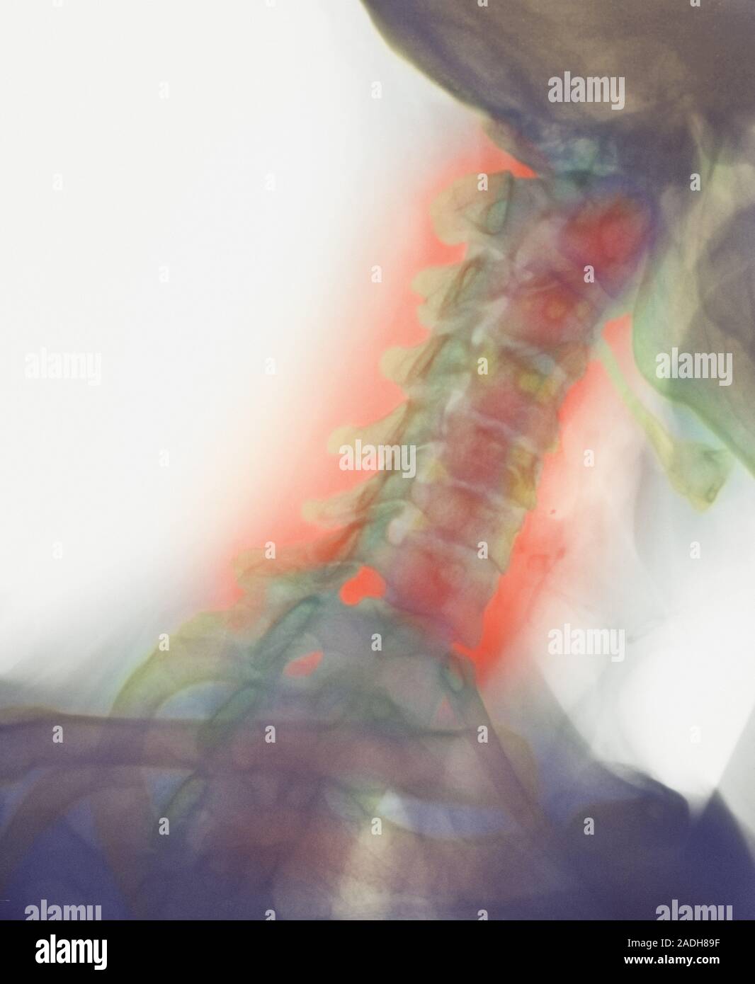 Osteoarthritis of the neck. Coloured Xray of a side view of the neck