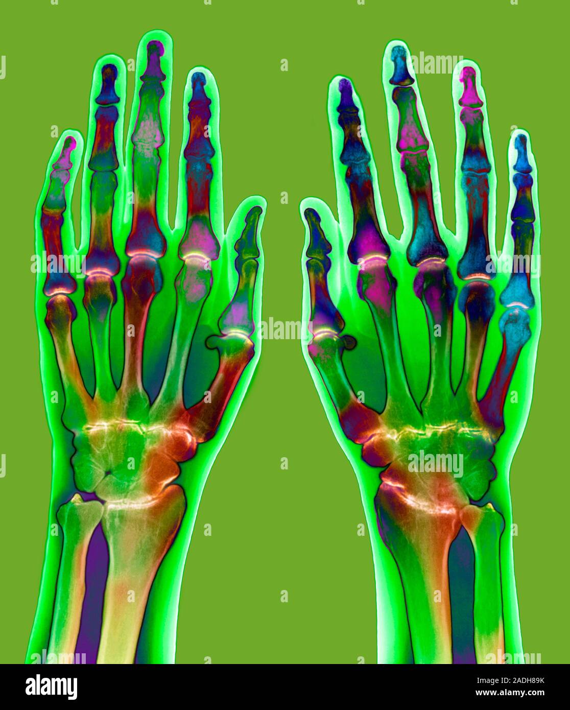 Arthritic hands. Coloured Xray of a pair of hands showing rheumatoid