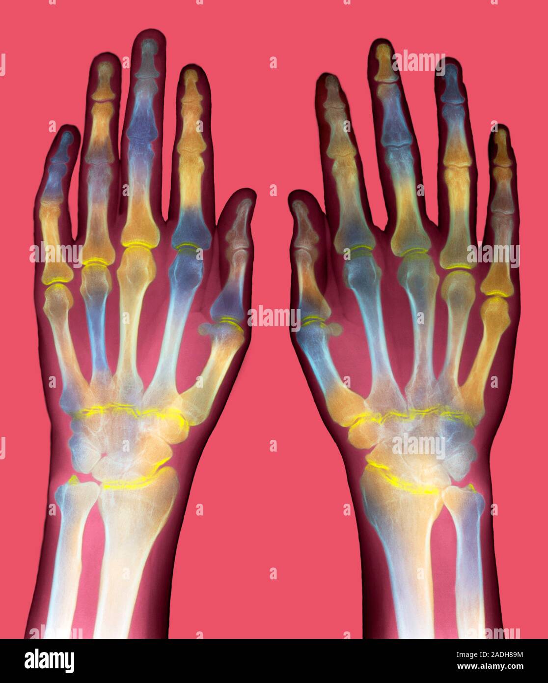 Arthritic hands. Coloured Xray of a pair of hands showing rheumatoid