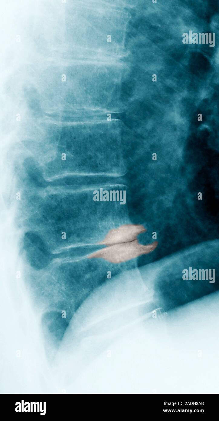 Diseased spine. Coloured X-ray of the thoracic spine of a patient with ...