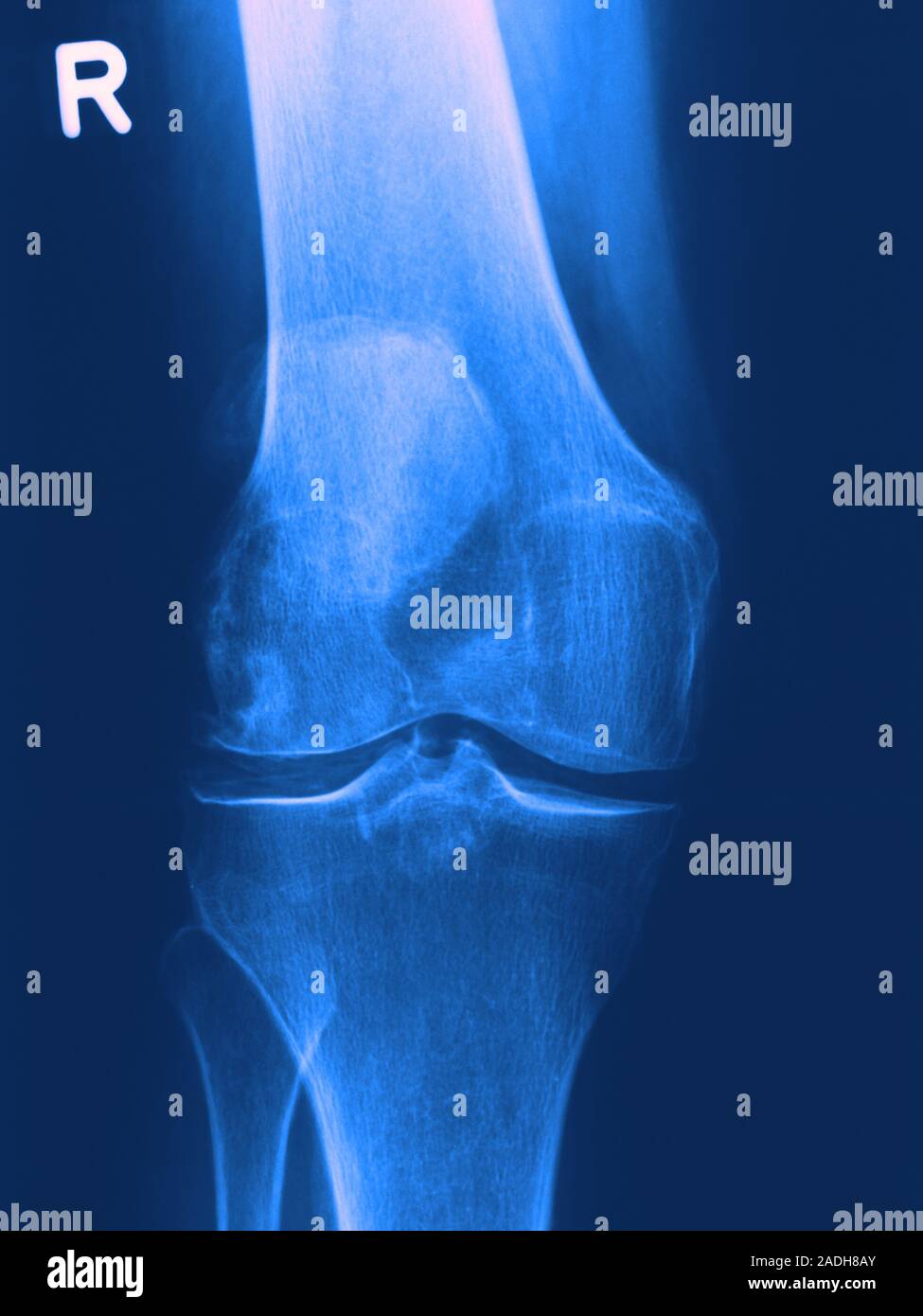 Arthritis. Computer artwork of an Xray of an arthritic knee Stock Photo Alamy