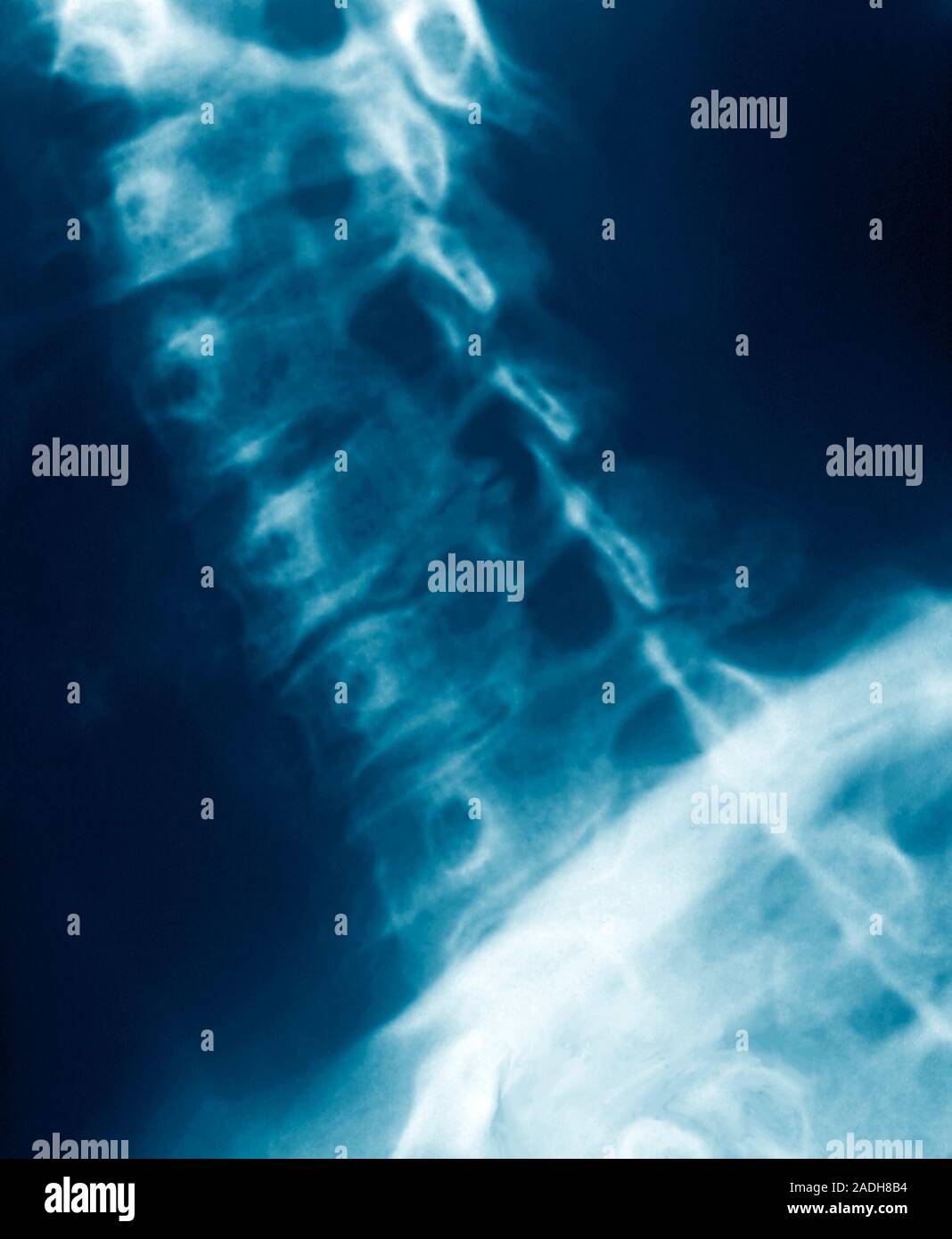 Osteoarthritis. Xray of a sideview of the neck of a patient with cervical osteoarthritis, a
