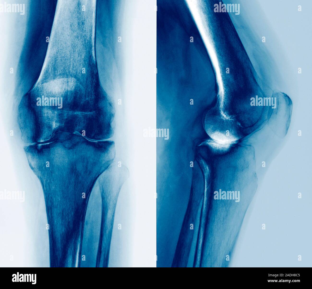 Arthritic knee. Coloured frontal (left) and profile (right)) Xrays of