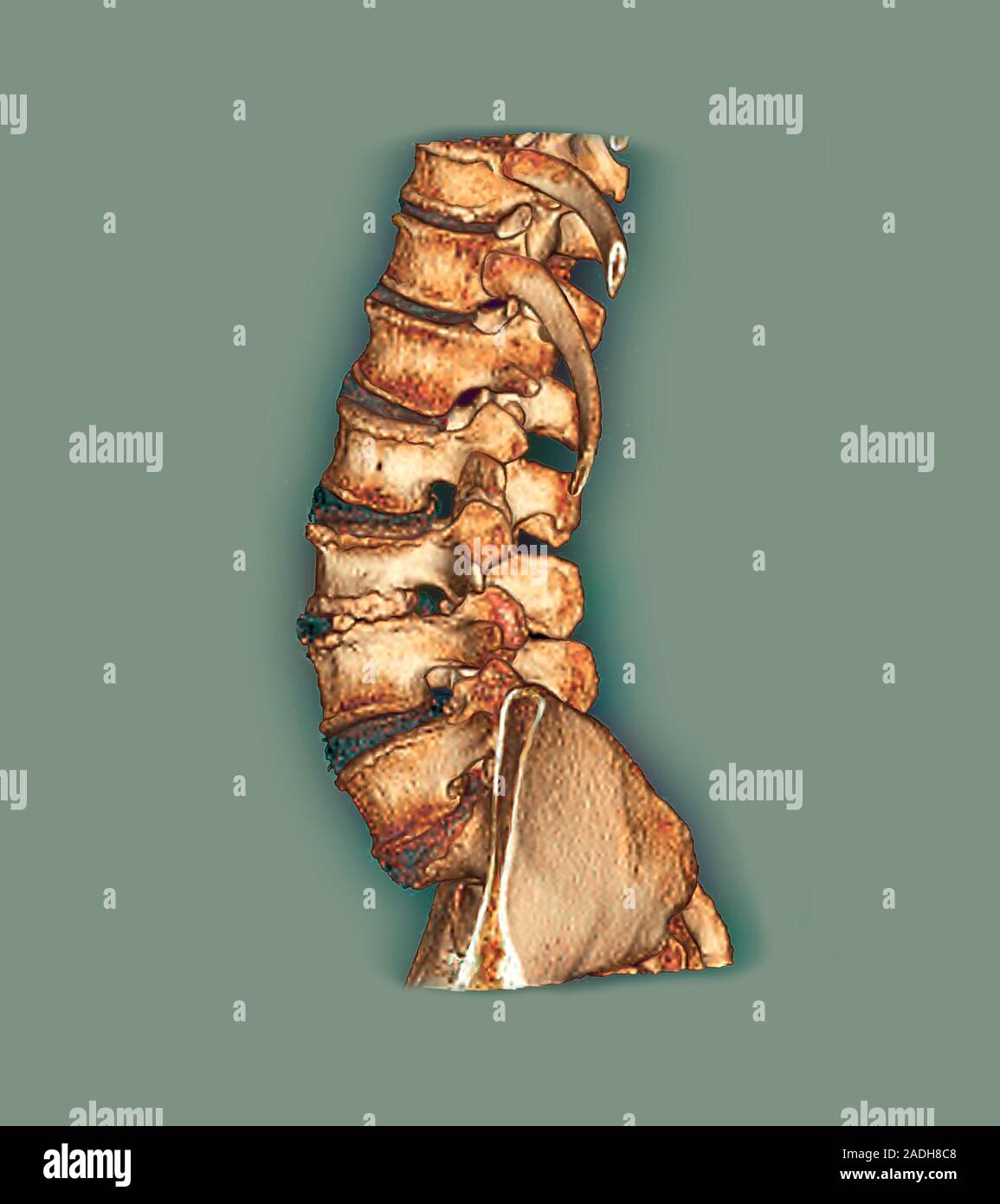 Arthritis of the spine. Coloured 3D computed tomography (CT) scan of a
