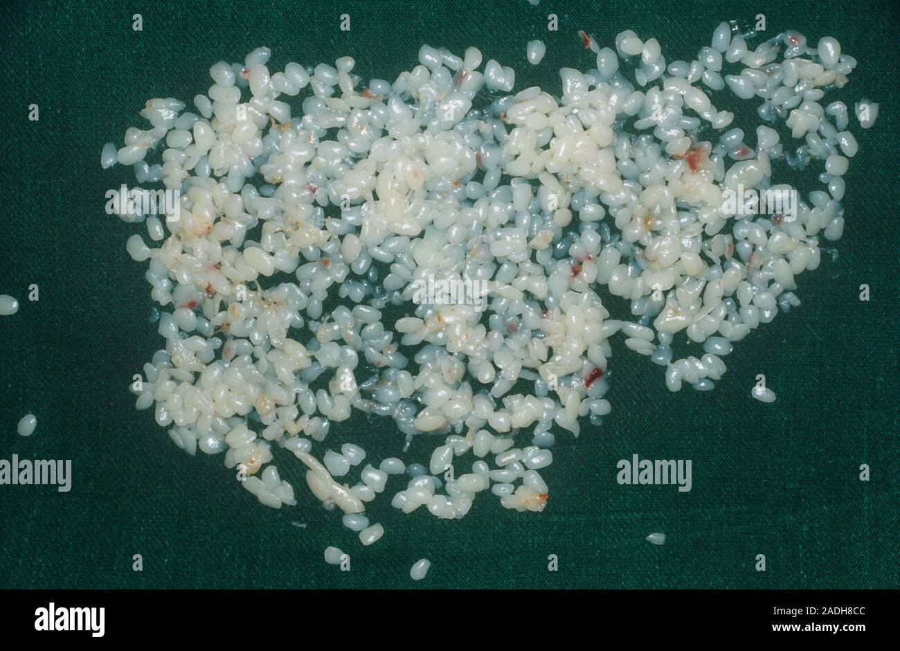 Arthritic joint debris. Cartilage and bone fragments removed from a